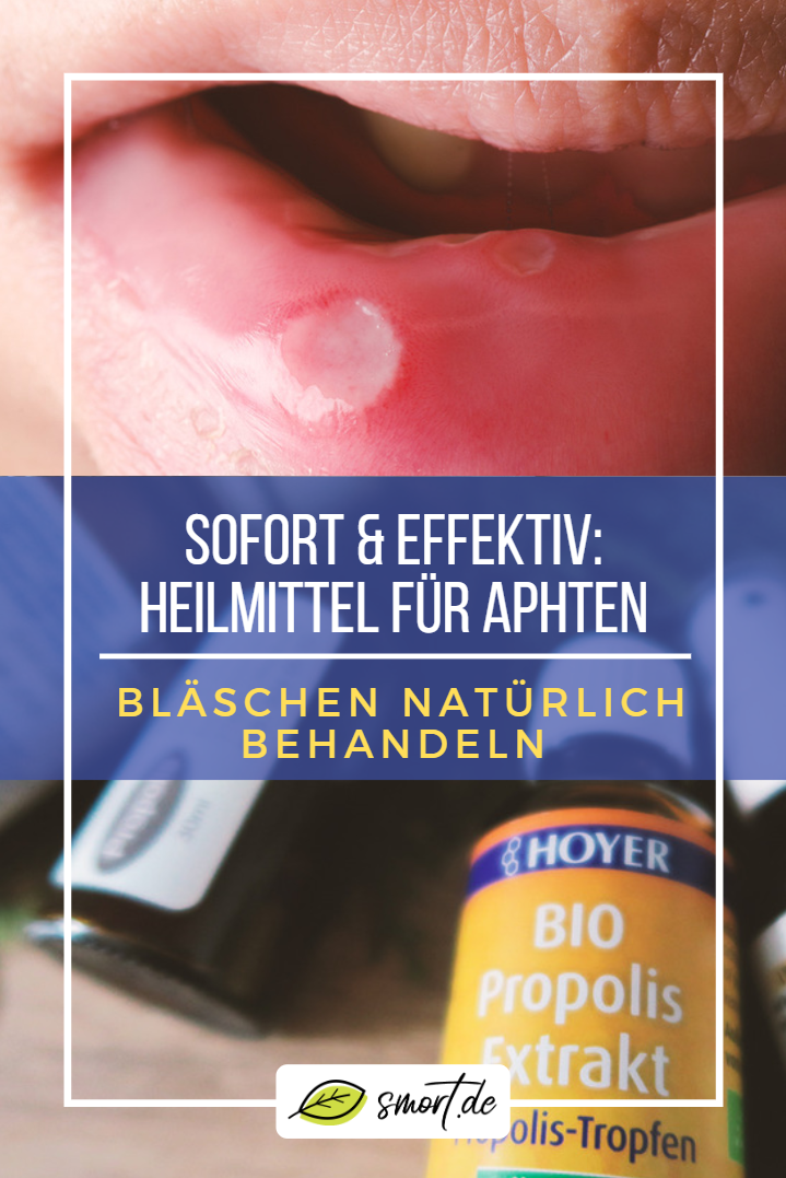 Soforthilfe gegen Aphten im Mund die besten natürlichen Heilmittel Soforthilfe gegen Aphten im Mund die besten natürlichen Heilmittel